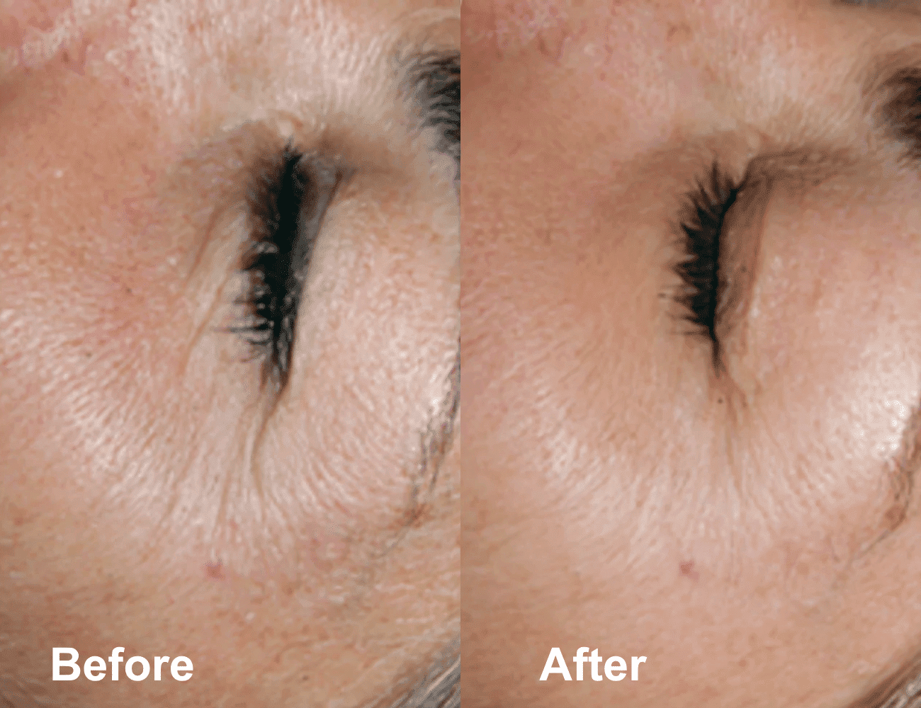Before and after image showing skin improvement around the eyes.