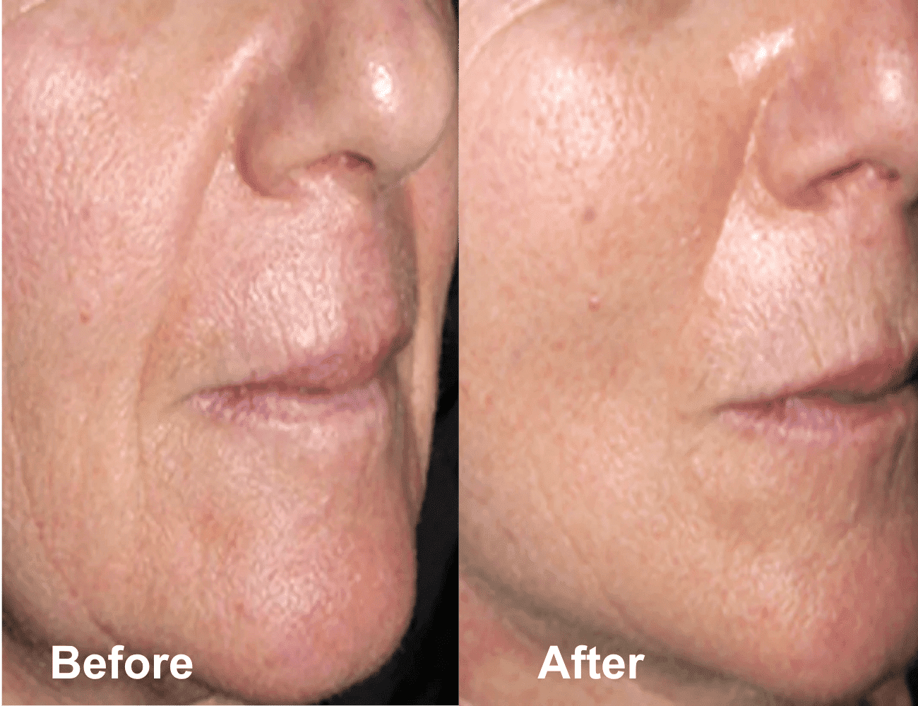 Close-up of a face showing skin improvement, labeled "Before" and "After".