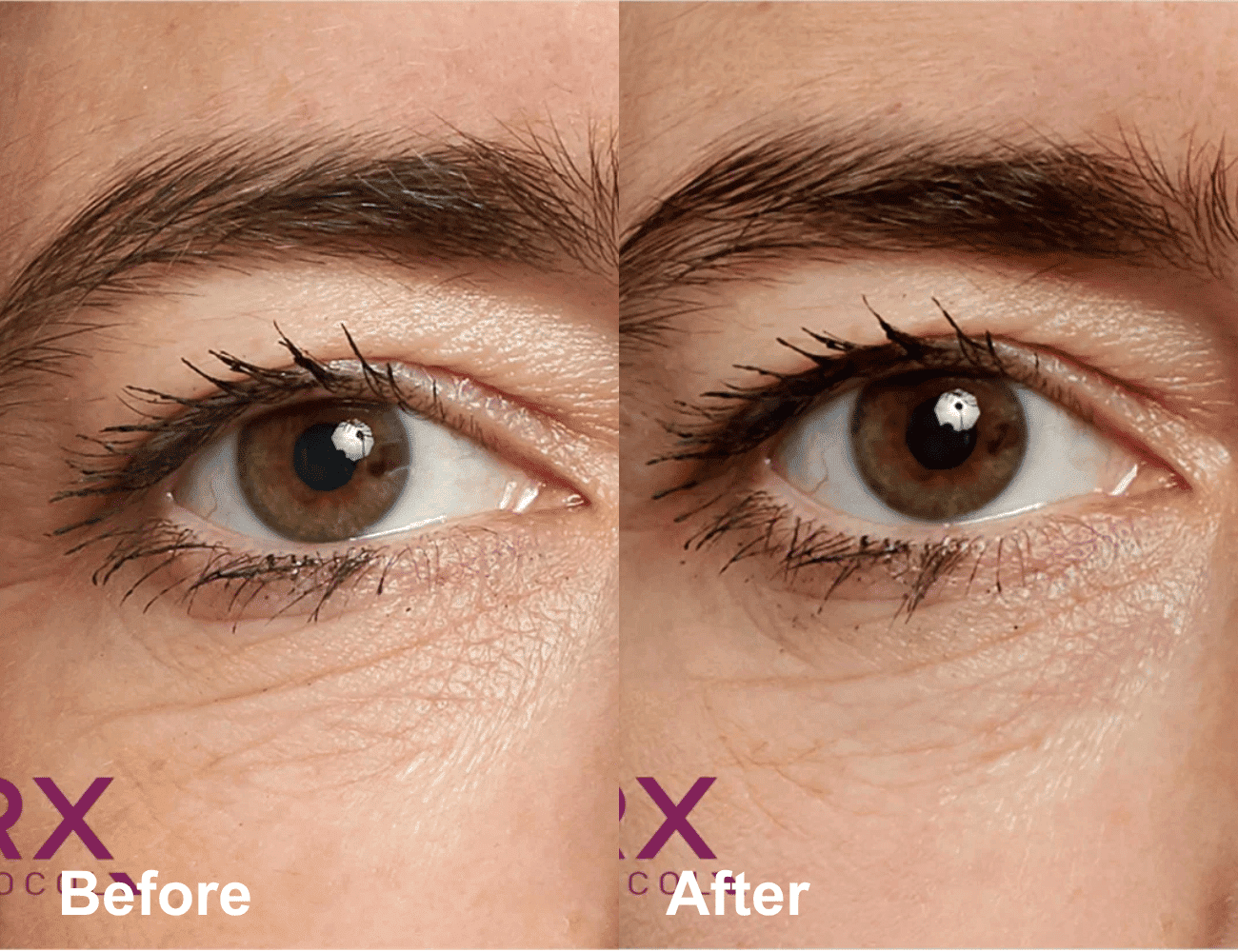 Before and after comparison of an eye with enhanced eyelash appearance.