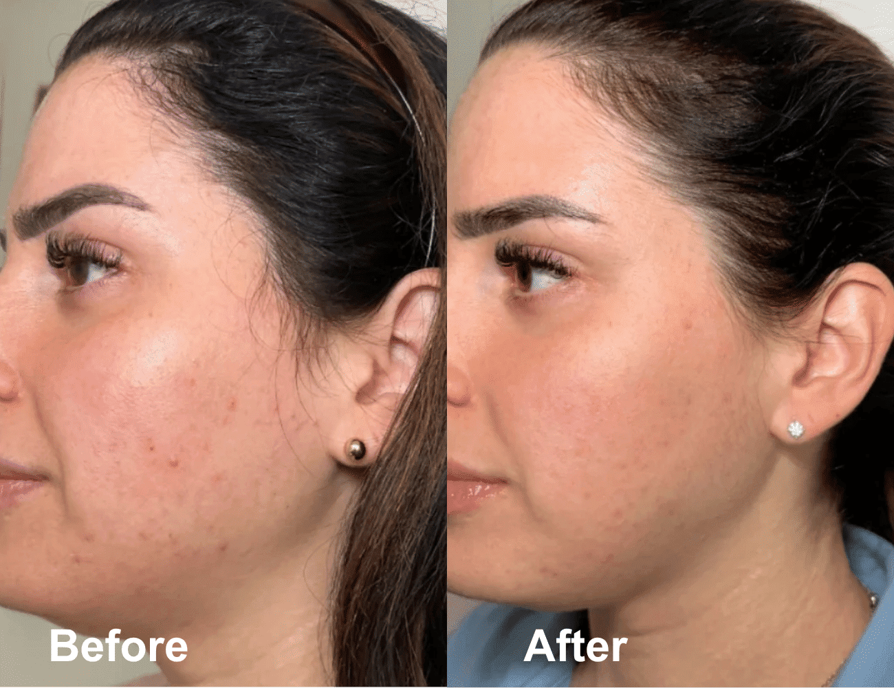 Side-by-side of a woman's face before and after skin treatment.