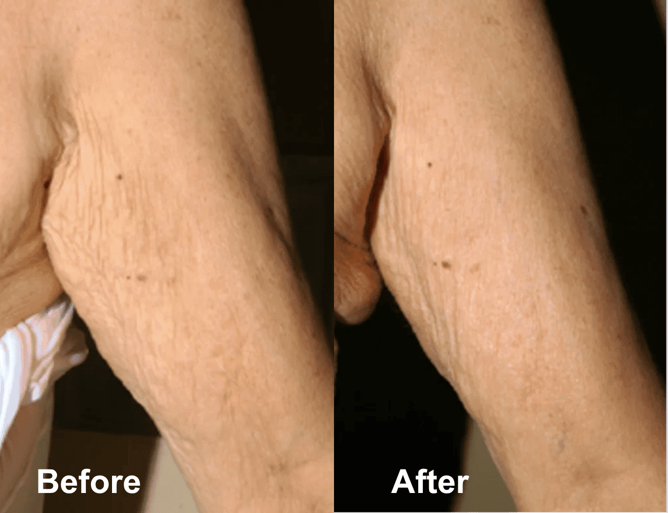 Before and after comparison of skin treatment on the forearm.